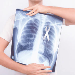 lung cancer