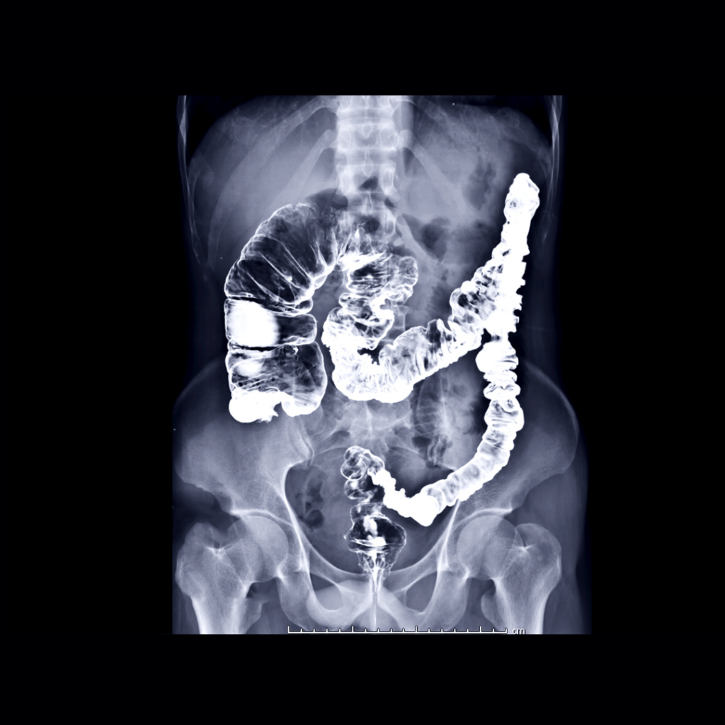 colorectal cancer x-ray -  DetecTogether
