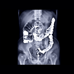 Colon Cancer x-ray image