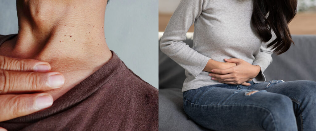 Skin and Bladder Cancer Awareness Mont image